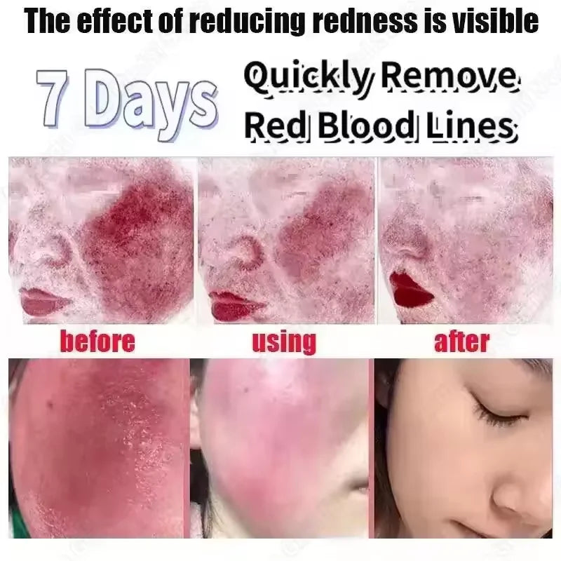 Mascarilla reparadora de enrojecimiento Facial, mejora rápida la sequedad de la piel sensible, suero calmante hidratante, eliminación de Rosacea de sangre roja, cuidado de belleza