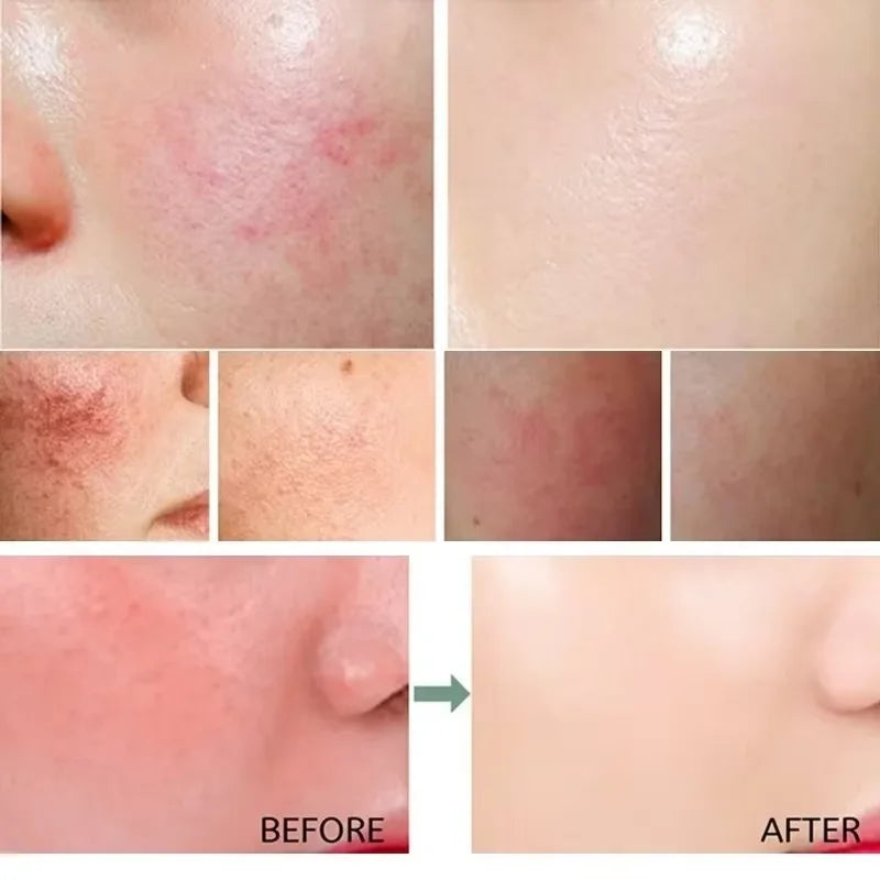 Mascarilla reparadora de enrojecimiento Facial, mejora rápida la sequedad de la piel sensible, suero calmante hidratante, eliminación de Rosacea de sangre roja, cuidado de belleza