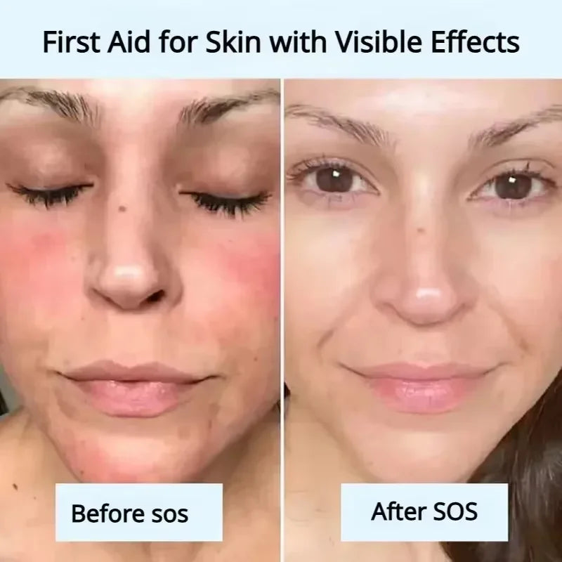 Mascarilla reparadora de enrojecimiento Facial, mejora rápida la sequedad de la piel sensible, suero calmante hidratante, eliminación de Rosacea de sangre roja, cuidado de belleza