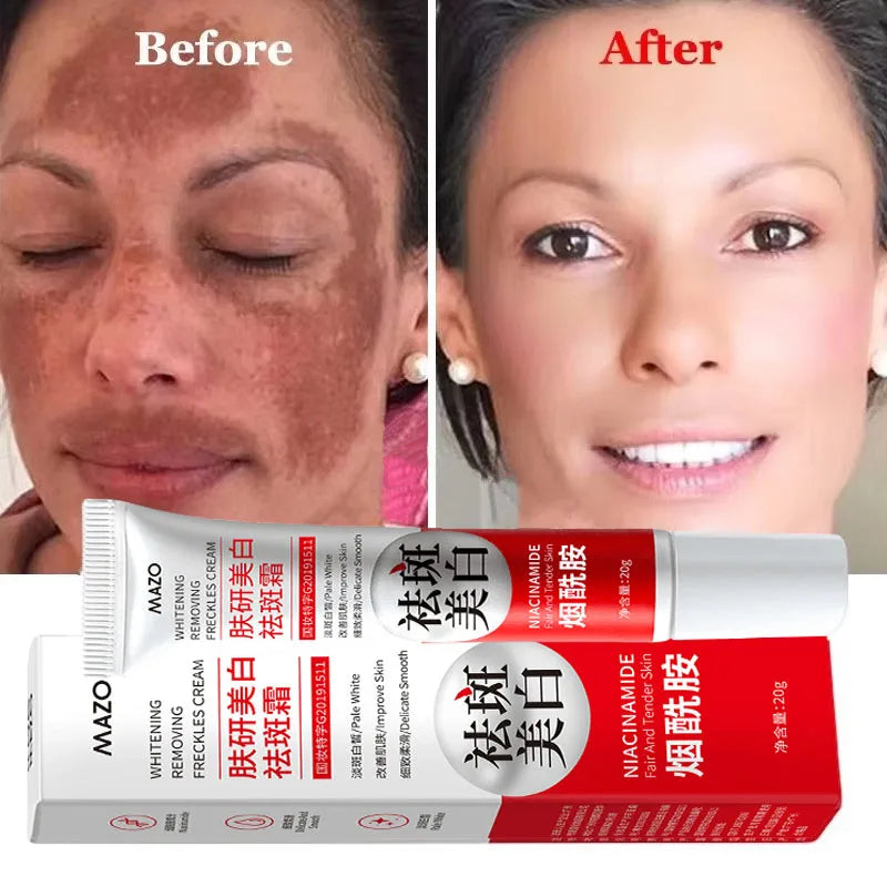 Potente Crema Blanqueadora Quitamanchas Ilumina la Piel Rápidamente Elimina la Pigmentación de Melanina, el Melasma y las Manchas Oscuras Cuidado de la Piel Coreano