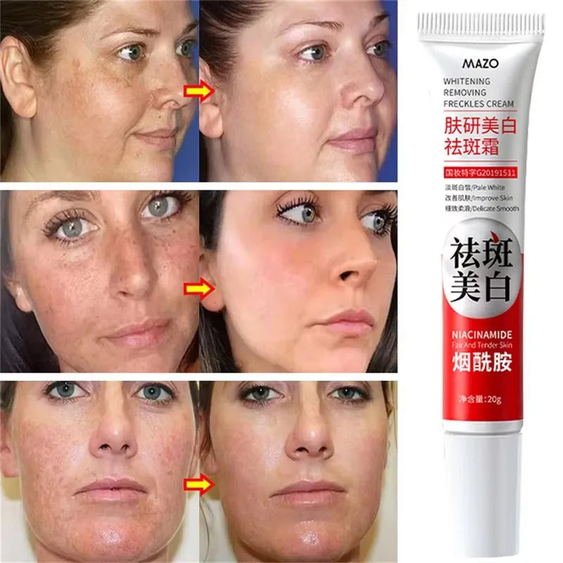 Potente Crema Blanqueadora Quitamanchas Ilumina la Piel Rápidamente Elimina la Pigmentación de Melanina, el Melasma y las Manchas Oscuras Cuidado de la Piel Coreano